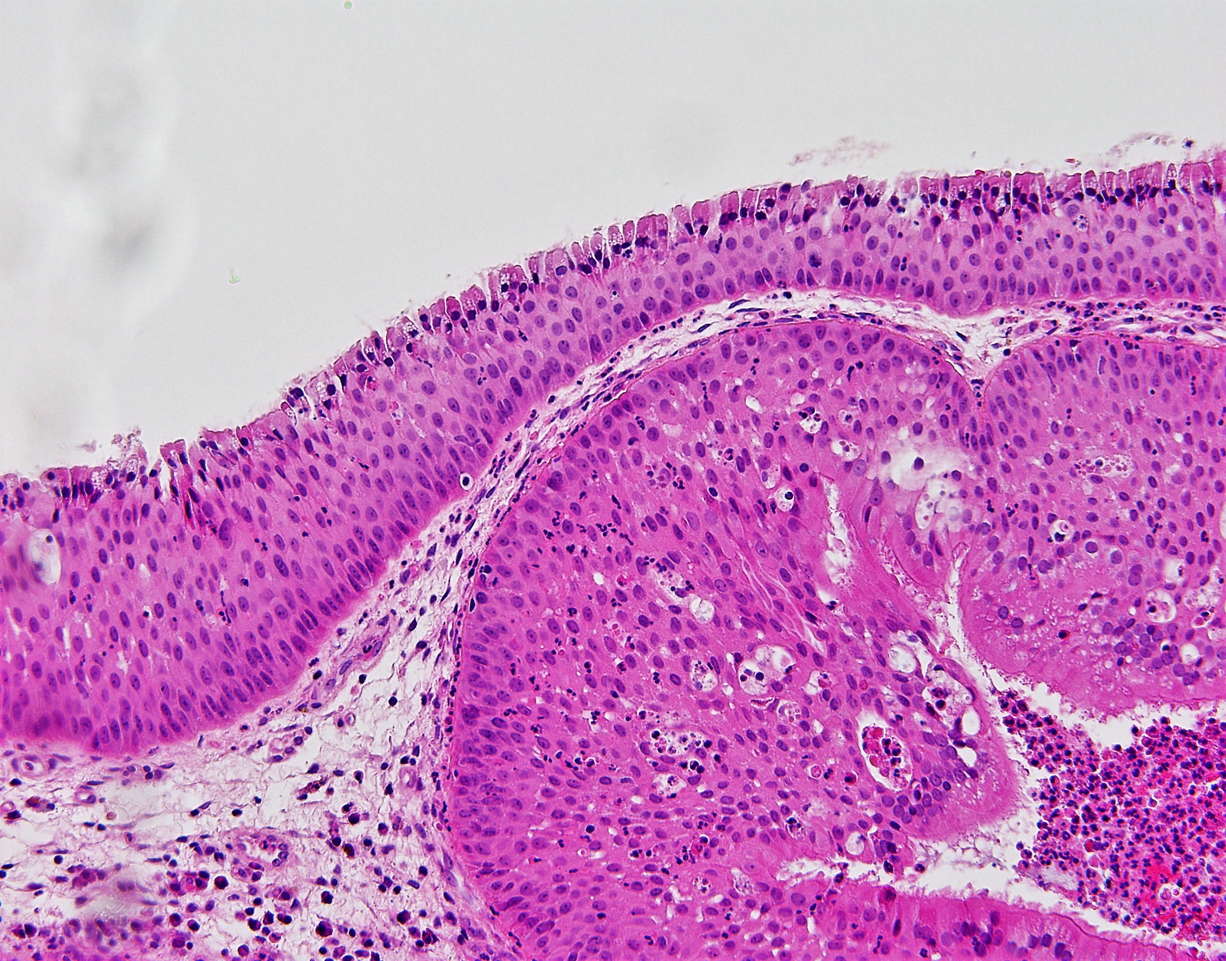 Inverted Papilloma Global Pathology Teaching And Education Program